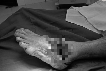 Bệnh nhân không may bị máy cắt cỏ cắt đứt 2/3 bàn chân trái.
