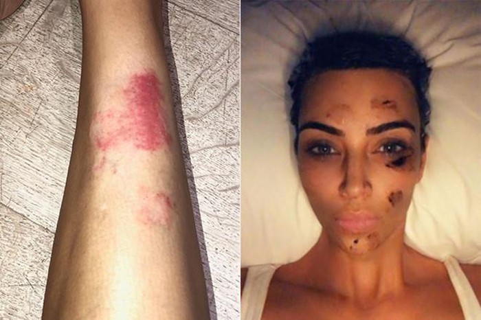 Kim Kardashian chia sẻ gương mặt với nhiều vết đỏ do bệnh vảy nến gây ra.