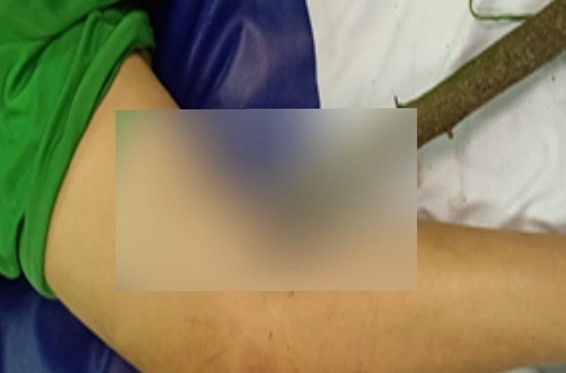 Phẫu thuật thành công bé trai 11 tuổi bị cành cây đâm xuyên đùi