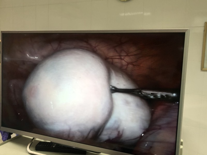 Hình ảnh khối u buồng trứng kích thước lớn trong ổ bụng bệnh nhân 13 tuổi. Ảnh: BV.
