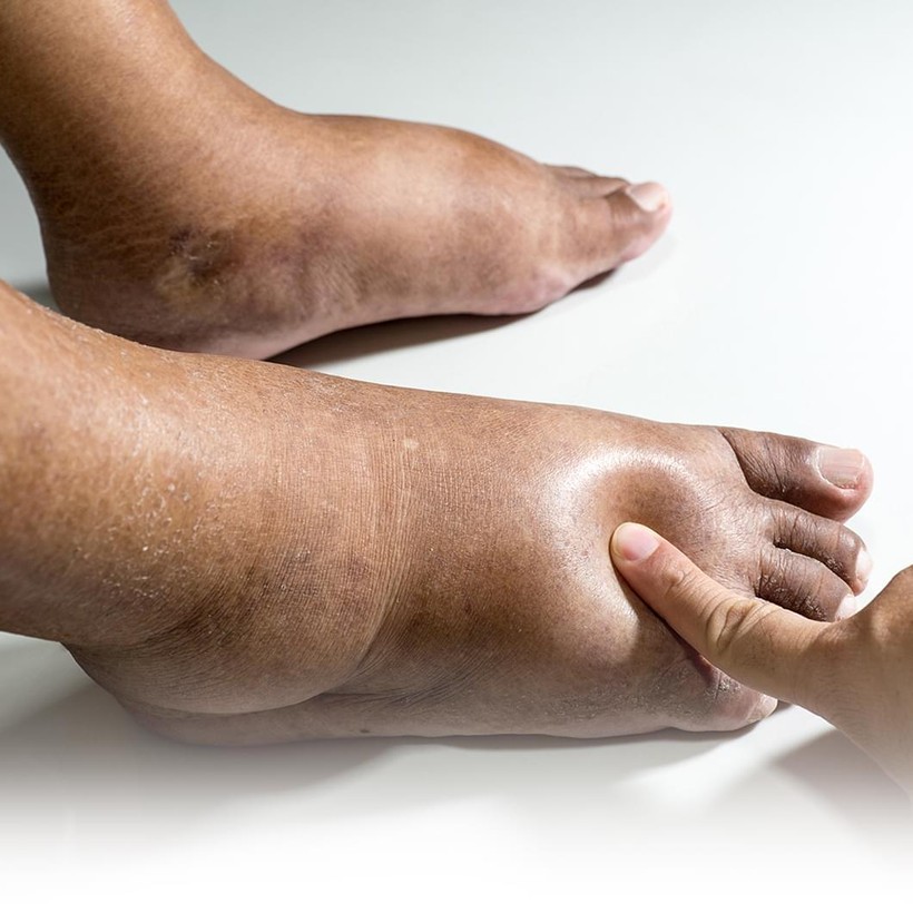 Chăm sóc bàn chân tiểu đường rất quan trọng, nhằm phòng tránh những biến chứng nguy hiểm. Ảnh: BV ĐK tỉnh Phú Thọ.