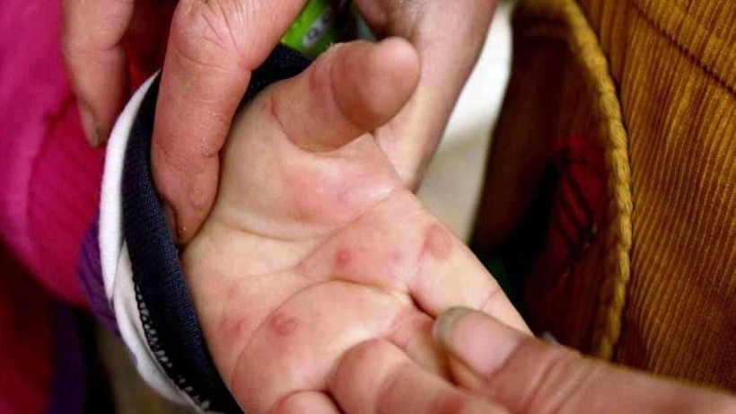'Cúm cà chua' gây nổi mụn nước trên da giống tay chân miệng và đậu mùa khỉ. Ảnh: India Today.