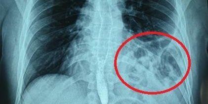 Phim X-quang cho thấy bóng khí của đại tràng ở trên ngực trái bệnh nhân. Ảnh: BV.
