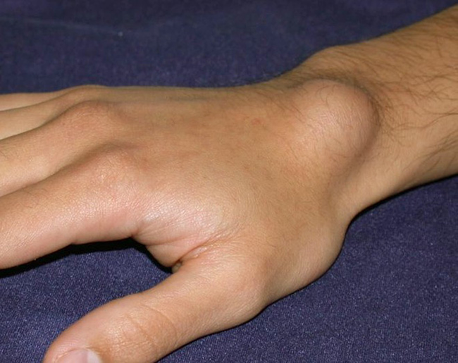 Theo Webmd, u bao hoạt dịch khớp cổ tay là một khối u hoặc sưng lên trên một khớp hoặc gân (mô kết nối cơ với xương).