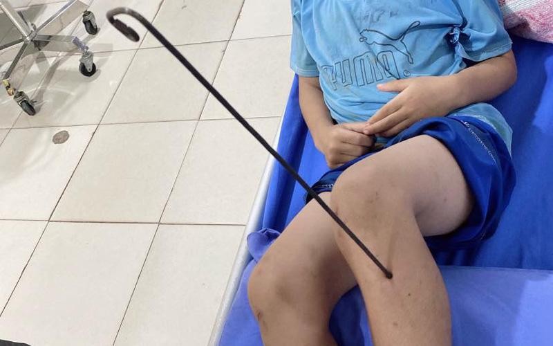 Bệnh nhi 9 tuổi nhập viện với mũi tên kim loại cắm vào chân. Ảnh: BVĐKKV Bắc Quang 
