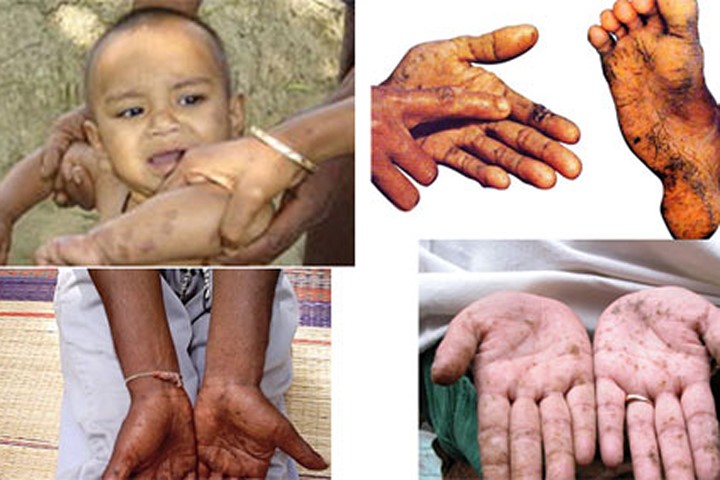 Biểu hiện của bệnh nhiễm chì ở trẻ em